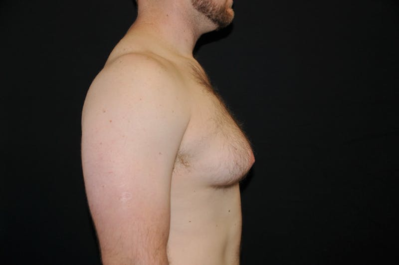 Gynecomastia Before & After Gallery - Patient 379084 - Image 1