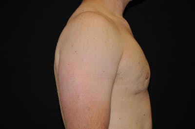 Gynecomastia Before & After Gallery - Patient 379084 - Image 2