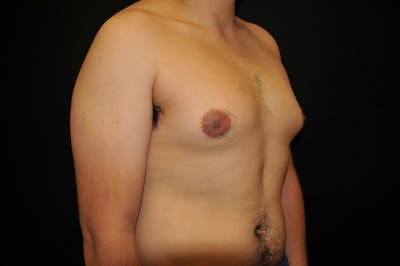 Gynecomastia Before & After Gallery - Patient 194705 - Image 1