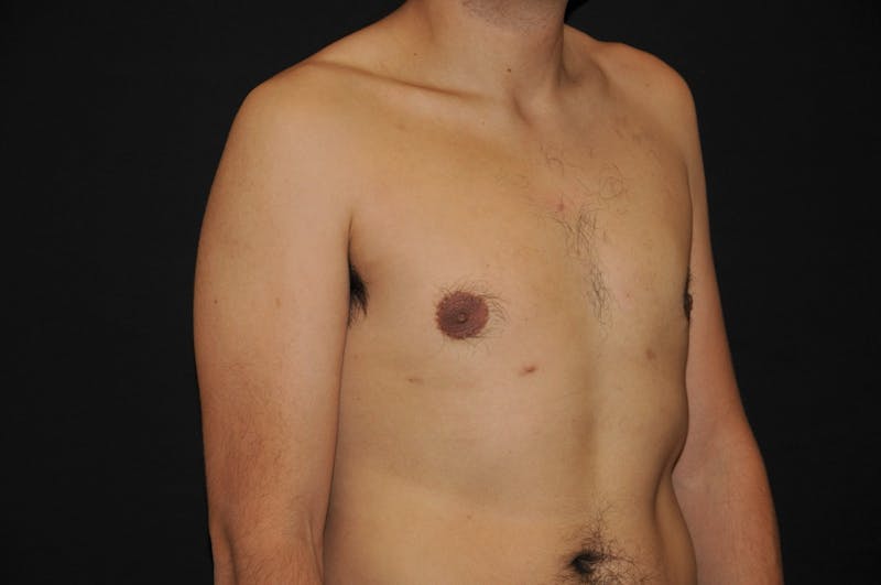 Gynecomastia Before & After Gallery - Patient 194705 - Image 2