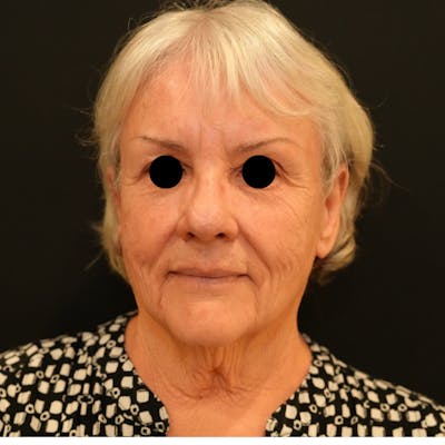 Facelift Before & After Gallery - Patient 325027 - Image 1