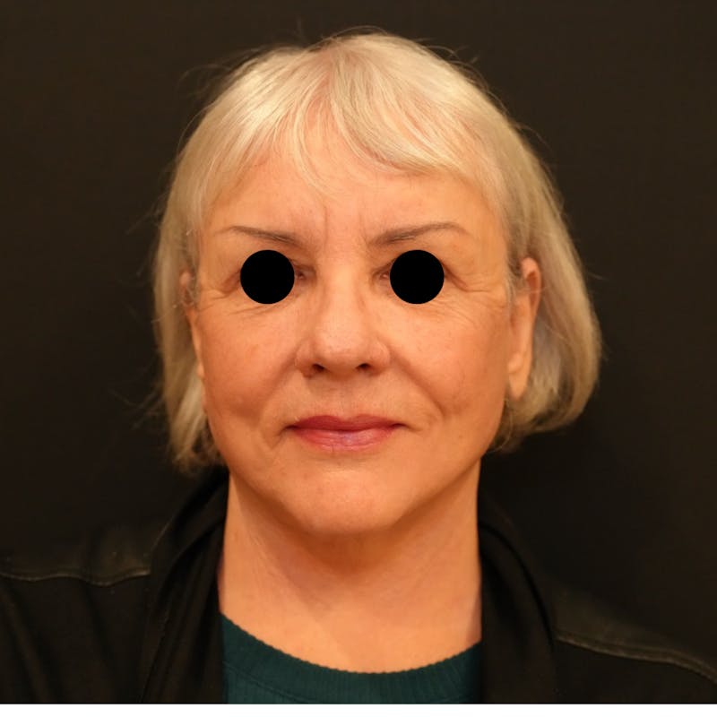 Facelift Before & After Gallery - Patient 325027 - Image 2