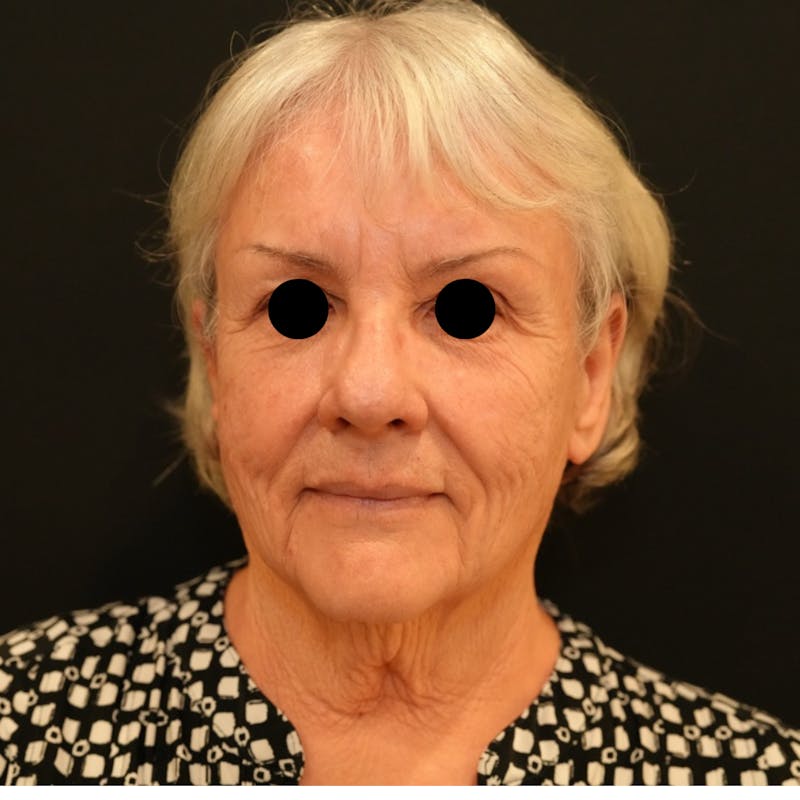 Neck Lift Before & After Gallery - Patient 369297 - Image 1