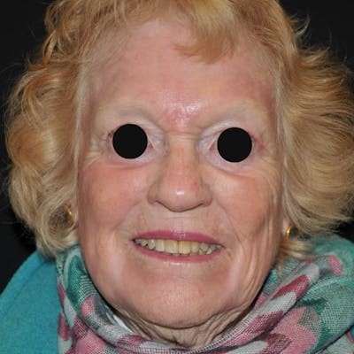 Chemical Peel Before & After Gallery - Patient 142586 - Image 2