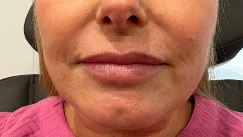Injectables Before & After Gallery - Patient 418335 - Image 1