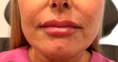 Injectables Before & After Gallery - Patient 418335 - Image 2