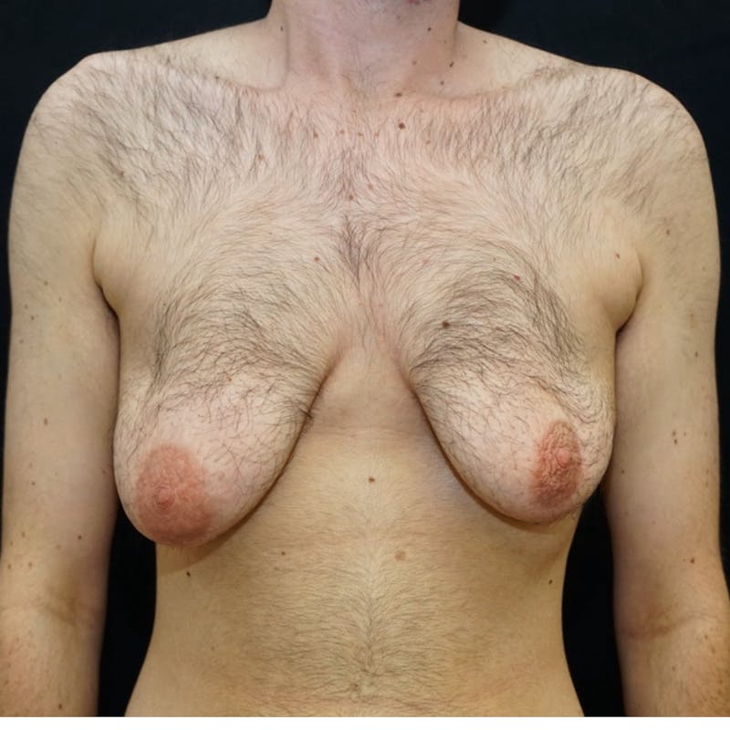 Top Surgery Before & After Gallery - Patient 130931 - Image 1