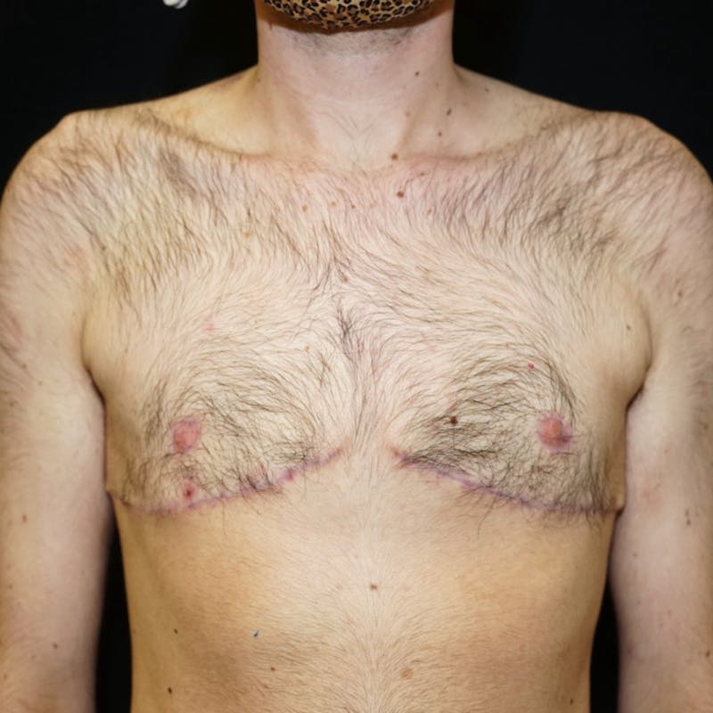 Top Surgery Before & After Gallery - Patient 130931 - Image 2