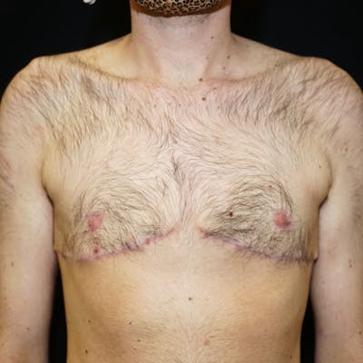 Top Surgery Before & After Gallery - Patient 130931 - Image 2