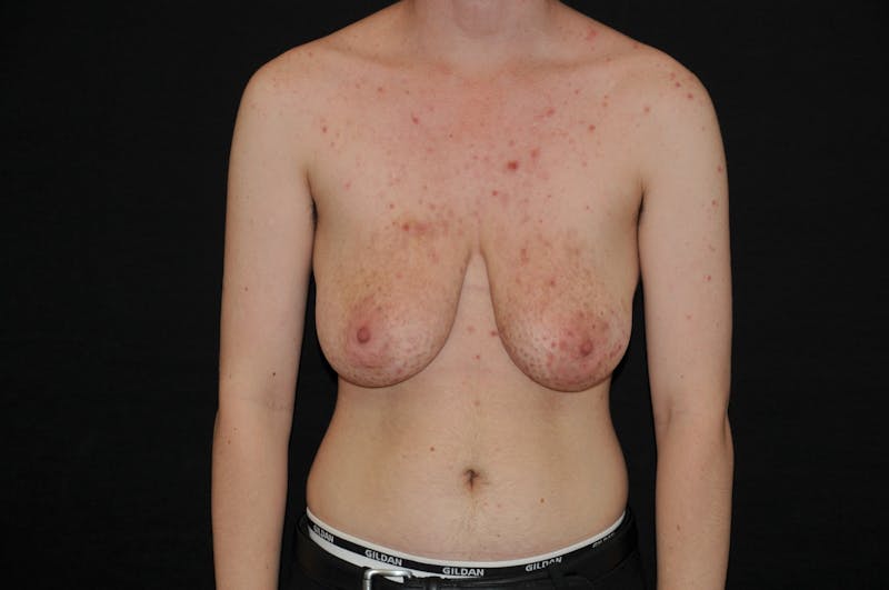 Top Surgery Before & After Gallery - Patient 102776 - Image 1