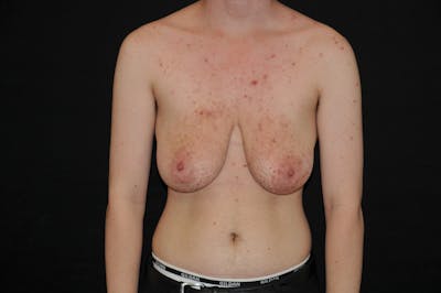 Top Surgery Before & After Gallery - Patient 102776 - Image 1