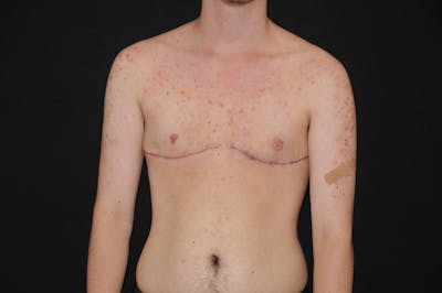 Top Surgery Before & After Gallery - Patient 102776 - Image 2