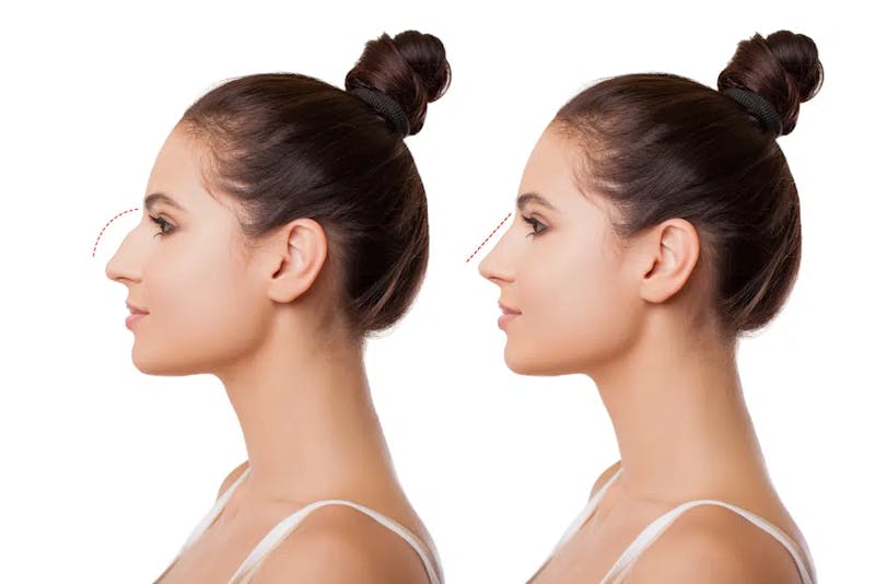 rhinoplasty before and after images