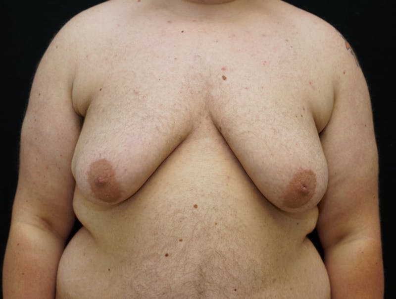 Top Surgery Before & After Gallery - Patient 681736 - Image 1