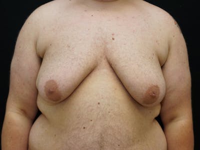 Top Surgery Before & After Gallery - Patient 681736 - Image 1