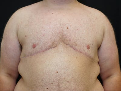 Top Surgery Before & After Gallery - Patient 681736 - Image 2