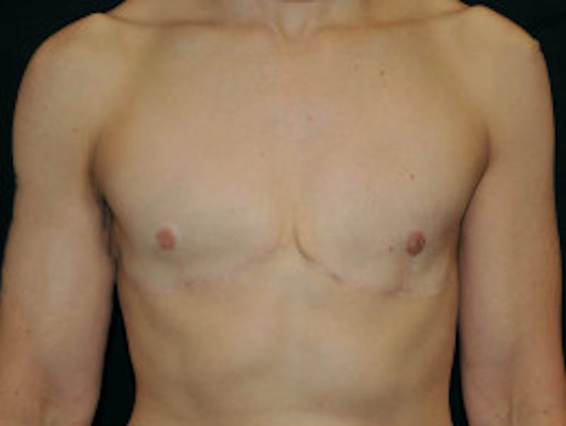 Top Surgery Before & After Gallery - Patient 289328 - Image 2