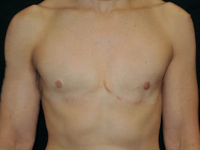 Top Surgery Before & After Gallery - Patient 289328 - Image 2