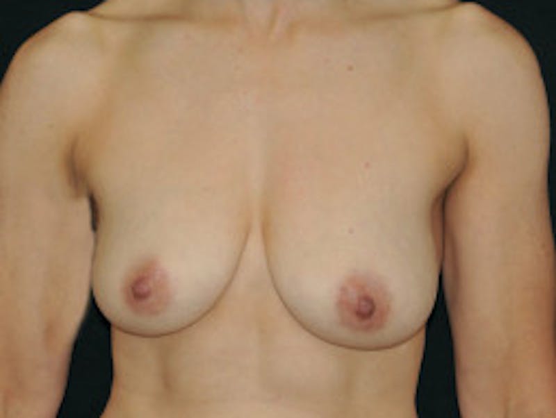 Top Surgery Before & After Gallery - Patient 289328 - Image 1