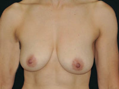 Top Surgery Before & After Gallery - Patient 289328 - Image 1