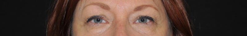 Blepharoplasty Before & After Gallery - Patient 134963 - Image 1
