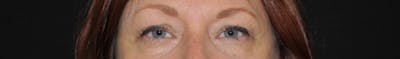 Blepharoplasty Before & After Gallery - Patient 134963 - Image 1
