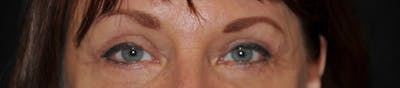 Blepharoplasty Before & After Gallery - Patient 134963 - Image 2