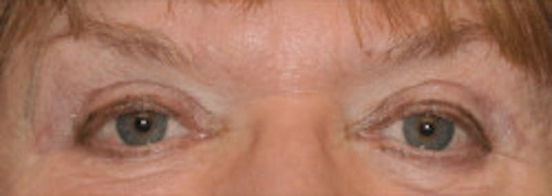 Blepharoplasty Before & After Gallery - Patient 317524 - Image 2