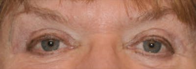 Blepharoplasty Before & After Gallery - Patient 317524 - Image 2