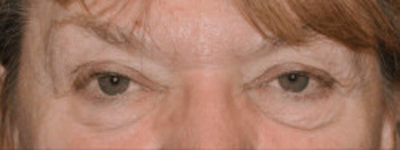 Blepharoplasty Before & After Gallery - Patient 317524 - Image 1