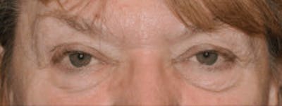Blepharoplasty Before & After Gallery - Patient 317524 - Image 1