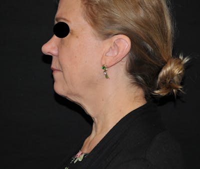 Facelift Before & After Gallery - Patient 269585 - Image 1