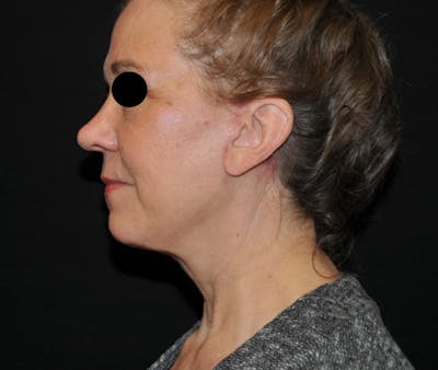 Facelift Before & After Gallery - Patient 269585 - Image 2