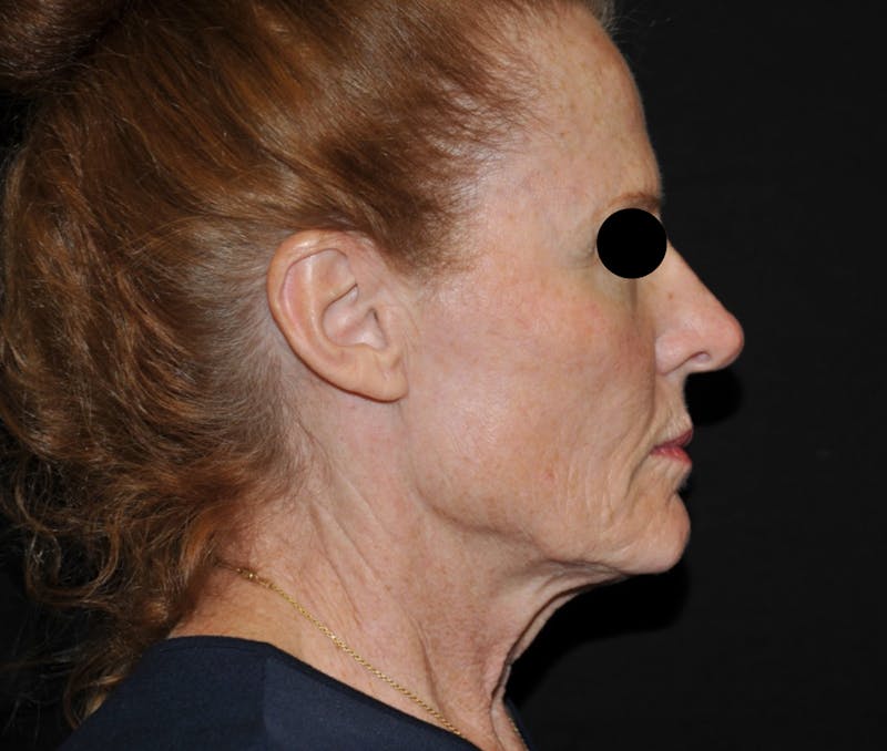 Facelift Before & After Gallery - Patient 115923 - Image 1