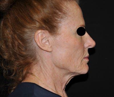 Facelift Before & After Gallery - Patient 115923 - Image 1