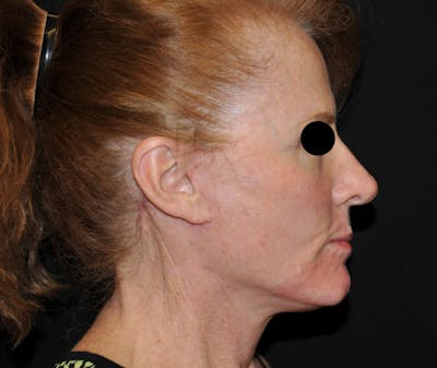 Facelift Before & After Gallery - Patient 115923 - Image 2