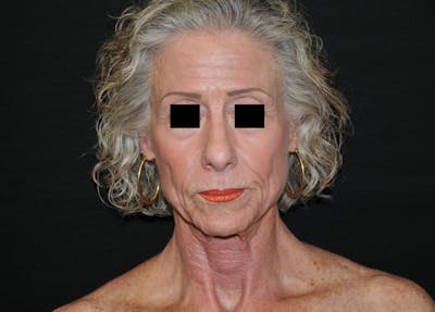 Neck Lift Before & After Gallery - Patient 172251 - Image 1