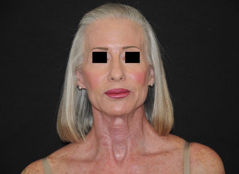 Facelift Before & After Gallery - Patient 135717 - Image 2