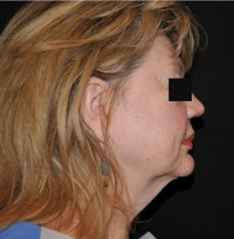 Facelift Before & After Gallery - Patient 272503 - Image 1