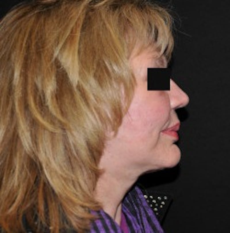 Facelift Before & After Gallery - Patient 272503 - Image 2