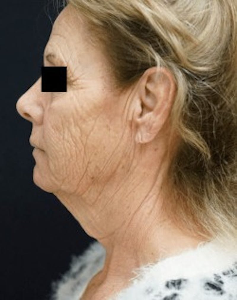 Facelift Before & After Gallery - Patient 105707 - Image 1