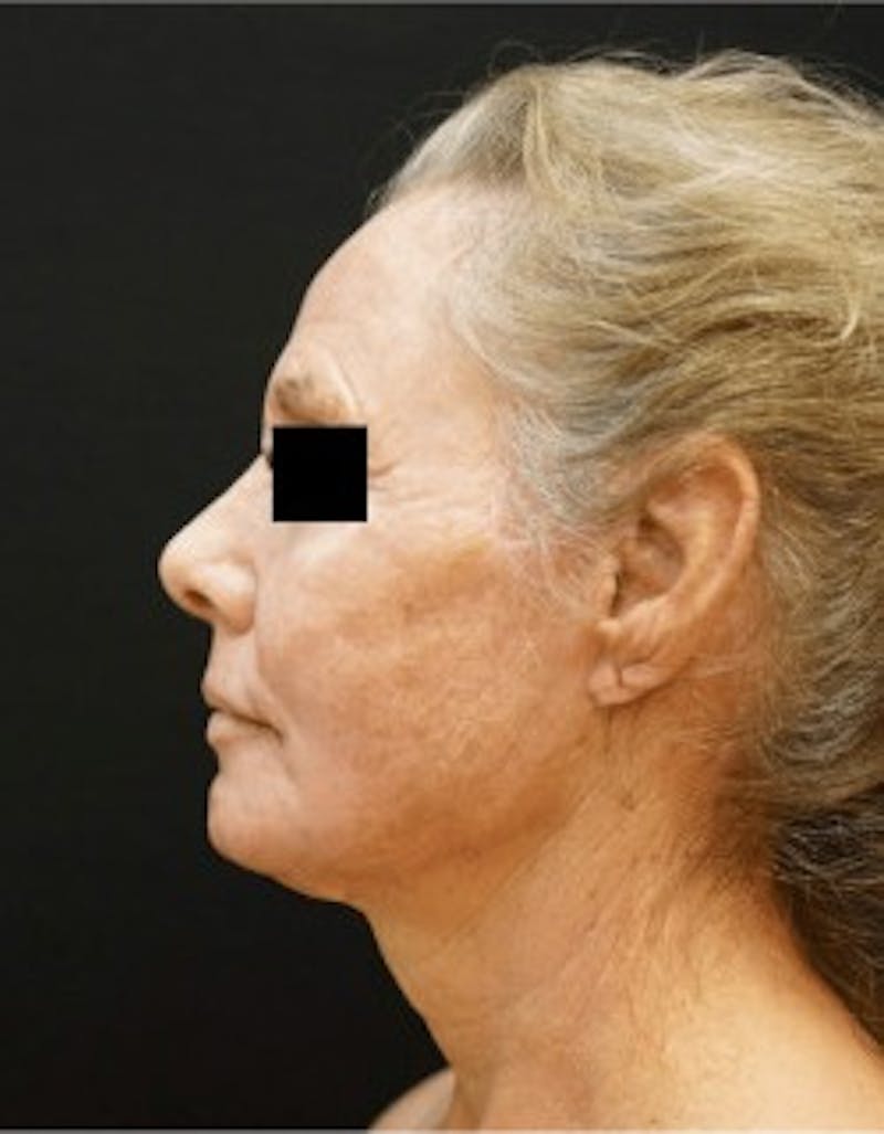 Facelift Before & After Gallery - Patient 105707 - Image 2