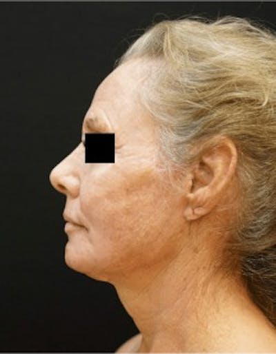 Neck Lift Before & After Gallery - Patient 234684 - Image 2