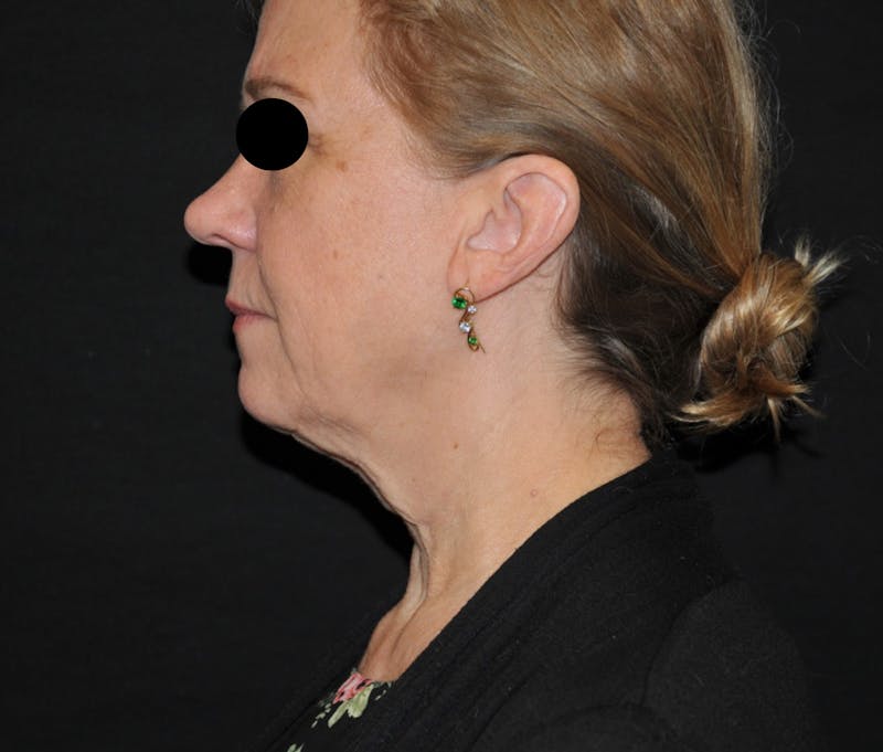 Neck Lift Before & After Gallery - Patient 669226 - Image 1