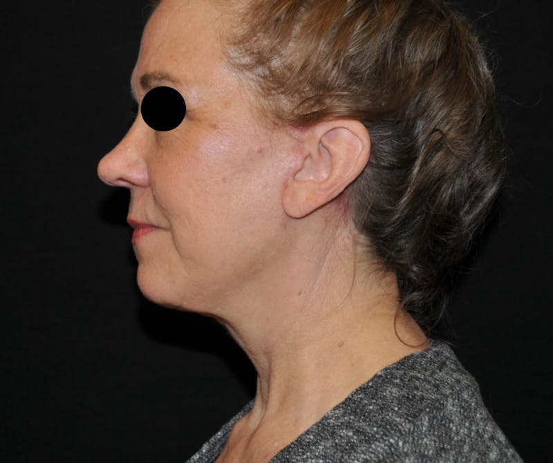 Neck Lift Before & After Gallery - Patient 669226 - Image 2