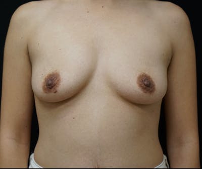 Breast Augmentation Before & After Gallery - Patient 239842 - Image 1