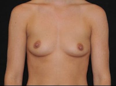 Breast Augmentation Before & After Gallery - Patient 112116 - Image 1