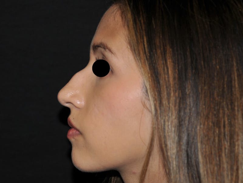 Rhinoplasty Before & After Gallery - Patient 123369 - Image 1