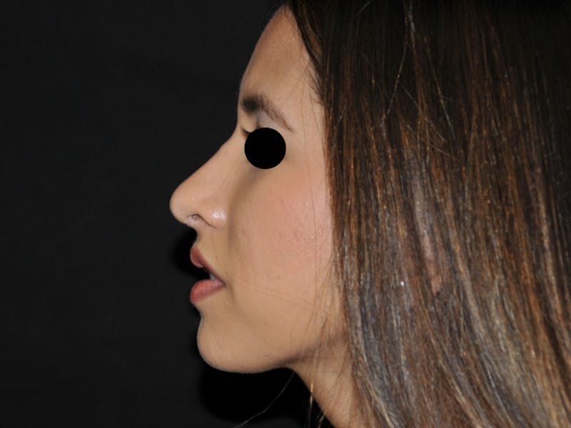 Rhinoplasty Before & After Gallery - Patient 123369 - Image 2