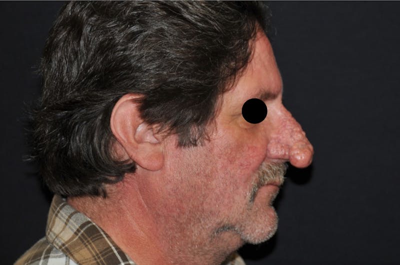Rhinoplasty Before & After Gallery - Patient 873549 - Image 1